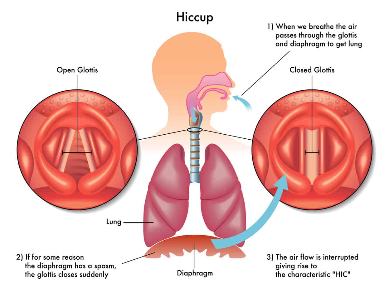 why-spicy-foods-cause-hiccups-and-what-to-do-about-it-spicy-exchange